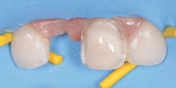 LE BRIDGE CANTILEVER : une solution de temporisation pour la perte d’une dent temporaire antérieure ?